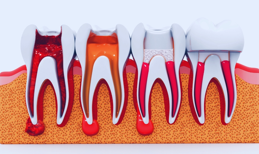 signs you might need a root canal